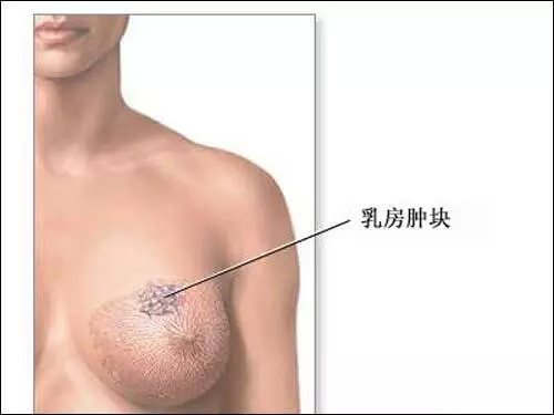 女性必须了解的乳腺癌的食疗方法