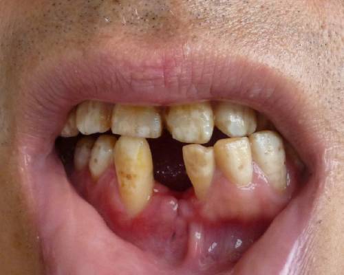 认识成人牙齿校正的危害性