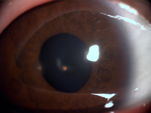 白眼球出血的病因是什么