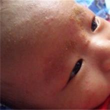 新生儿湿疹用什么药 湿疹护理方法介绍