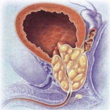 前列腺增生伴结石是什么 有哪些症状