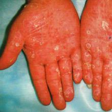 二期梅毒疹 慢性全身性性传播疾病