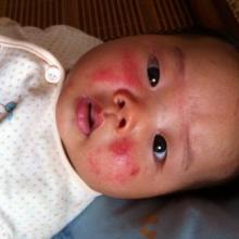 婴儿湿疹最佳治疗方法 婴儿湿疹的预防